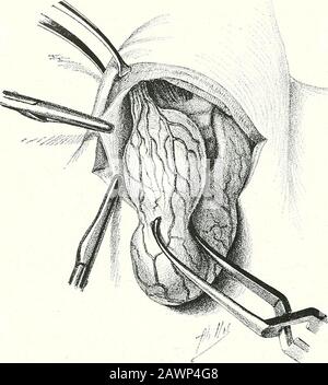 Terapie chirurgiche e tecniche operative . Fig. 337.--tiroidectomia unilaterale.Quarta fase: Formazione di un pedicle singolo. 202 TERAPIE CHIRURGICHE E TECNICA OPERATIVA. Fig. 338. Thyroidectomy.Quarta fase: Enucleazione del tumore e formazione del pedicle superiore. Foto Stock
