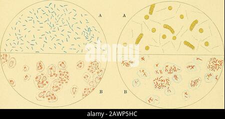 Un trattato pratico sulla diagnosi medica : per studenti e medici . A. Bacillus Comma. B Gonococcus.Fig. 5. A. Spirilla Ricorrente. B. lebbra.Fig. 6. Foto Stock