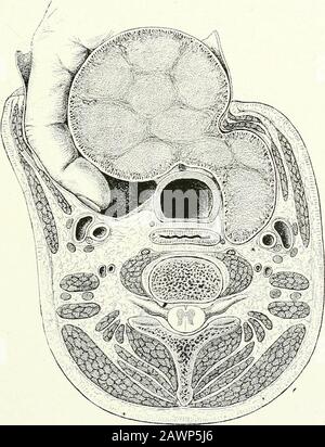 Terapie chirurgiche e tecniche operative . Fig. 332.-Tiroidectomia. Prima e seconda fase. A destra della figura si vede la sezione dei muscoli sub-ioidi; dall'altro lato, l'elevazione della capsula e l'esposizione del corpo tiroideo. Fig. 333.- Enucleazione Extraglandulare. Il dito è stato introdotto nello spazio permeabile situato tra il viscerasheath e la capsula ghiandolare, e luxates forzatamente il tumore attraverso la ferita. 200 TERAPIE CHIRURGICHE E TECNICA OPERATIVA Foto Stock