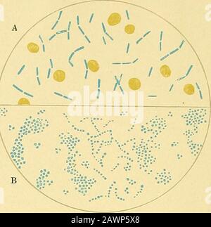 Un trattato pratico sulla diagnosi medica : per studenti e medici . A. Bacilli Tubercoli. B. Pneumococco. A. Anthrax. B. Streptococcus e Staphylococcus. Fig. 3. Fig. 4. Foto Stock