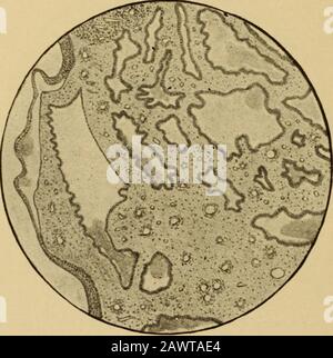 Le malattie delle donne : un manuale per gli studenti e i praticanti . surfaceis generalmente tumid con questo overgrown glandular tissue.Occasionalmente questo sviluppo ghiandolare proietta come apedunculated processo dalla bocca dell'utero, ed isthen denominato un polypus mucoso; due o più possono bepresent. Sono punteggiati con pori minuti che indicano gli orifizi delle ghiandole e sono molli. Essi di solito springfrom l'endometrio vicino al sistema operativo, che è generallypatulous quando questi corpi adenomatosi pedunculated sono 176 MALATTIE DELLE DONNE. Istologicamente, sono composti da un asse offibrous e. Foto Stock