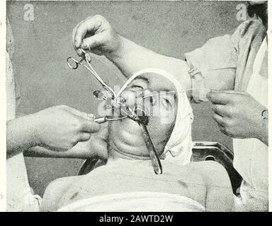 Terapie chirurgiche e tecniche operative . Fig. 224.- Epithelioma Localizzato della Parte anteriore Del Tongue.Operation mediante Il Metodo Bloody. Divisione della mucosa della tlie dietro la sede dell'ulcerazione. 116 TERAPIE CHIRURGICHE E TECNICA OPERATIVA. Fig. 225.-- Epithelioma della Parte anteriore Della Lingua. La parte posterioi del tumore è stata staccata. Sutura immediata della ferita dietro il neoplasma. Foto Stock