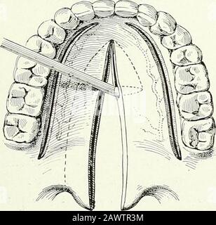 Terapie chirurgiche e tecniche operative . Fig. 197.-Ukano-Staphyloerhapht. Prima tappa: Liberatrici di incisioni. Decollazione del palato muco-membranoso witliTrelats raspatory. La decollazione dovrebbe essere perseguita fino a b, al fine di mobilitare il velum palati. Fig. 198.-Ukano-Staphylorhaphy.Bilaterali vivificazione unlining. Foto Stock