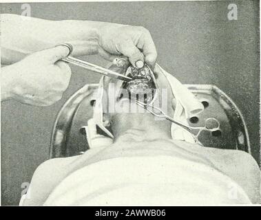 Terapie chirurgiche e tecniche operative . Fig. 173. - Resezione Della Porzione Mediana Della Mascella Inferiore Mediante Incisione Submascellare Orizzontale. Primo stao-e: Sezione degli strumenti. Fig. 174.- resezione Della Porzione Mediana Della Mascella Inferiore mediante Incisione Submascellare Orizzontale. Seconda fase: Dissezione del lembo anteriore della ferita e esposizione delle OPERAZIONI tumorali SULLA TESTA Foto Stock