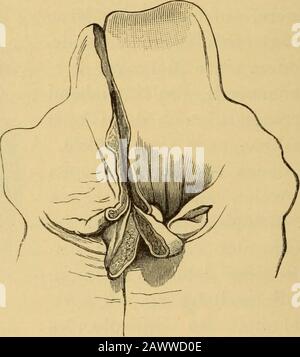 Vorlesungen über die Krankheiten des Kehlkopfes . Wie nun die weitere Untersuchung durch verticale Spaltung derfalschen Stimmbänder (Fig. 16 b) und dieser polypösen Geschwülste (Fig. 16 c) ergibt, bestehen dieselben aus der vorgestülpten Schleimhaut,rechts der vorderen Hälfte, links der vorderen zwei Drittel des sinusMorgagni mit eingeltem lockeren Zellgewebe. Da das Präparat lange Zeit in schlechtem Alkohol aufbewahrtworden war, und so eine feinere mikroskopische Untersuchung resultat-los bliebe, so sei nur blemerkt, dass nmakach roskopischem Aussehen dievorgestülpte Schleimhaut völlig norm Foto Stock