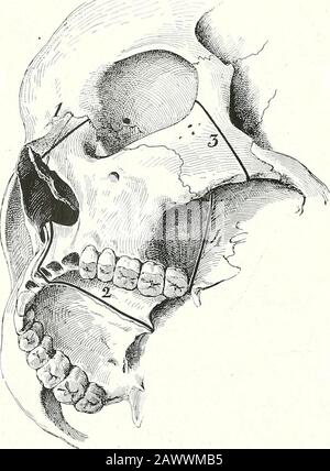 Terapie chirurgiche e tecniche operative . Fig. 153.- Sarcoma Del Confine alveolare della Mascella superiore che invade l'Arco Palatino. Diagramma dell'incisione palatina a V, che dovrebbe passare attraverso le sedi dei due primi premolari. Fig. 154.- diagramma Delle Quattro Sezioni Ossei necessarie per TotalExtriration op la Mascella superiore. Foto Stock