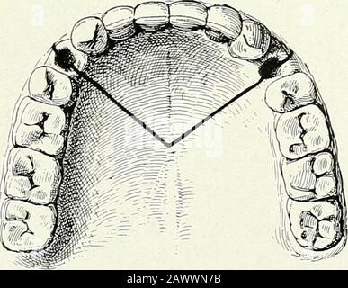 Terapie chirurgiche e tecniche operative . Fig. 152.- Sarcoma Del Confine alveolare della Mascella superiore che invade l'Arco Palatino. Diagramma della resezione ossea vista dalla parte anteriore. Fig. 153.- Sarcoma Del Confine alveolare della Mascella superiore che invade l'Arco Palatino. Diagramma dell'incisione palatina a V, che dovrebbe passare attraverso le sedi dei due primi premolari. Foto Stock