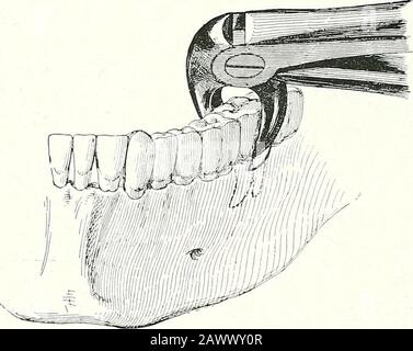 Terapie chirurgiche e tecniche operative . Fig. Rimozione Del Primo Loweb Molak.La stessa pinza è utilizzata per entrambi i lati. La linea scura indica la prima presa e l'altra inferiore. Nel caso delle pinze n° 9 (secondo dente inferiore sinistro di molaree saggezza), e n° 10 (denti corrispondenti del lato destro), la lama superiore, nell'apprensione del dente, si trova su un piano leggermente anterioreo a sinistra. V. Fig. 143.- Rimozione dell'ultimo Molare Inferiore del Lato sinistro.Il Buio Un© indica la presa Drsfc per lusatioa del dente. Se operiamo nella posizione Rosa con la testa girata indietro, i denti più bassi possono Foto Stock