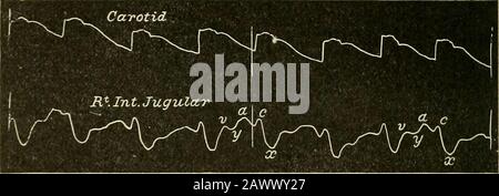 kenzie, The Study of the Pulse, 1902; anche Hirschfelder, American Journal of the Medical Sciences, settembre 1906, e Morrow, Brit-ish Med. Senza dubbio, la contrazione della auricola, ma per localizzare questa onda o, effettivamente, per interpretare a tutto l'impulso venoso complicatedè necessario avere un tracciato simultaneo dell'impulso arterioso, preferibilmente della carotide, o del battito apicale del cuore. Uno di questi ultimi tracciati consente di rilevare l'impulso venoso Foto Stock