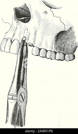 Terapie chirurgiche e tecniche operative . Fig. 135. -Estrazione di UpperCanine. Fig. Estrazione di un UpperCanine. La linea scura indicava la prima presa di disegno Schematico che mostrava in 1 il dente, che dovrebbe mobilitarlo. Prima presa del dente, con cui è Questa prima presa si prepara per il luxated. La pinza viene quindi sollevata fino all'estrazione, il livello del collo del dente mobilizzato che vi si stringe, e estrae senza difi&culty. Foto Stock