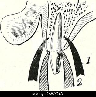 Terapie chirurgiche e tecniche operative . Fig. 135. -Estrazione di UpperCanine. Fig. Estrazione di un UpperCanine. La linea scura indicava la prima presa di disegno Schematico che mostrava in 1 il dente, che dovrebbe mobilitarlo. Prima presa del dente, con cui è Questa prima presa si prepara per il luxated. La pinza viene quindi sollevata fino all'estrazione, il livello del collo del dente mobilizzato che vi si stringe, e estrae senza difi&culty. Foto Stock