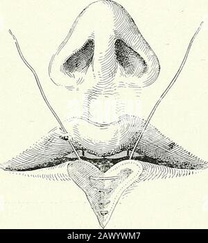 Terapie chirurgiche e tecniche operative . Fig. 46.-resezione V di LipFOR Inferiore A piccolo annullamento. Posizione della prima sutura muco-mucoussutura. Fig. 47.- V-Eesection of Lower^LipFOR A Small Cancroid. La sutura della porzione verticale della mucousmembrana è quasi completata; la disposizione della quarta sutura. Foto Stock