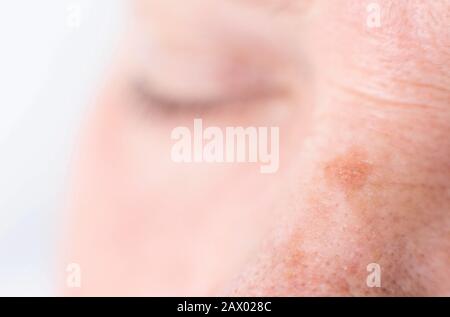 macchie di età sul viso di una donna con pelle secca e rughe, sfondo, macro Foto Stock