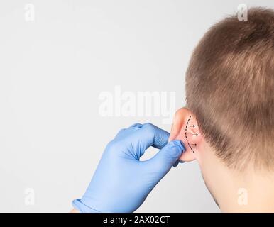 Un medico chirurgo plastico esamina l'orecchio di un paziente maschio per un'operazione di otoplastica. Il concetto di rimozione di sordità, spazio di copia, procedura Foto Stock