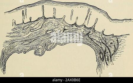 La patologia e il trattamento chirurgico dei tumori . acuto e la parte sul lato distale condomini a secernere, gli spazi pre-espositivi, a seconda dell'attività della funzione fisiologica della parte interessata, dilatano rapidamente, risolutendo la distensione della ghiandola o del condotto, con assottigliamento della parete. Se theob.struzione si forma lentamente e la quantità di secrezioni trattenute RI TENTION-CISTI. 651 si accumula lentamente, la cisti-parete è spesso enormemente ispessita dalla formazione di nuovo tessuto connettivo. La migliore illustrazione del formercondition è fornita da idronefrosi acuta, e del lat Foto Stock