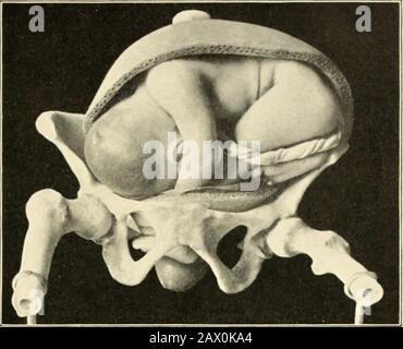 Un libro di testo di ostetricia . Fig. 248. - Presentazione spalla. ABXORMAI.RRIES IN ME( NANISM. 39*. Fig. 249. - posizione Trasversale del feto; estremità presenti. Foto Stock