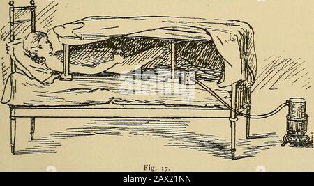 La cura della natura tedesca, e come praticarla . Fig. I6. BAGNO TURCO A LETTO. 57 trattamento attivo, come un bagno d'anca, o un stimolante pacchetto di vita dell'anca durante la notte, con impacchi per gambe o piedi; anche acquerottazione, impasti di ginocchio, bagni derivati per i piedi, e ultimo, non meno importante, con passeggiate a piedi nudi. [PLATINA.) BAGNI DI VAPORE A LETTO. Si tratta di una forma molto delicata di bagno di vapore, e può essere givento infanti così come per le persone anziane. Hanno avuto origine da Rikli, e per loro ha inventato un apparecchio regolare. La mattressis coperta da un grande pezzo di impermeabile, su cui è posata una coperta di lana di lamiera, su cui è stata posta Foto Stock