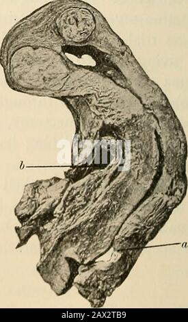 La patologia e il trattamento chirurgico dei tumori . Fig. 344.- Due miomi interstiziali vicino a ccrvi&gt;(dopo Winckel). Fig. 345.- Due miomi interstiziali vicino al fondo (dopo Winckel) : a, labbro posteriore; b, vescica. MIOMA. 487 consuetudine di descrivere questi tumori, in base alla loro posizione, come I. Interstiziale; 2. Submucoso ; 3. Subsieroso. Un tumore che è primariamente Foto Stock