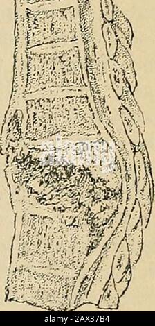 Chirurgia; la sua teoria e pratica . s una forma bassa di infiammazione distruttiva conseguente a Carie della spina dorsale (S. T i . 1 ,• ii. ? • r IU i.- Bartholomews Hos- leggera lacerazione o altro irjuiy 01 il cnrti- pitai Museum.)lage. Ma tuttavia comincia, presto involvesthe ossa adiacenti, distruggendoli con la cartilagine e portando alla deformità angolare. Il midollo spinale, situato nella parte posteriore della colonna, con l'eccezione di essere piegato, subisce però una piccola alterazione del suo calibro, eil midollo, come avviene la curvatura del canale, ma lentamente, in modo congrente Foto Stock