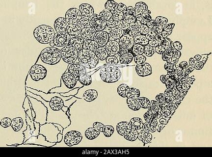 La patologia e il trattamento chirurgico dei tumori. Le del tumore è costituito da con- Fig. 333.-linfoma, che mostra cellule linfoidi e delicato reticolo di  ° (dopo Paget). Strati centrici di tessuto fibroso. La struttura atipica del tumore è caratterizzata dall'assenza di linfonodi ben definiti, mentre la struttura follicolare è ben servita. La superficie del tumore è liscia, e manca completamente teprolongazioni nel tessuto connettivo circostante che sono caratteristiche suchcospicue del linfangioma. I corpuscoli linfoidi, che sono solo occasionalmente presenti nel linfang Foto Stock