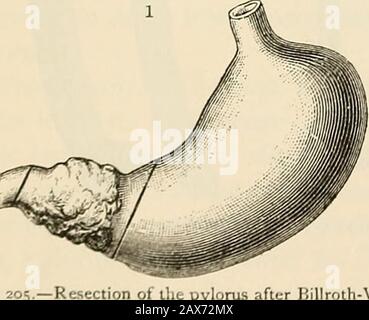 La patologia e il trattamento chirurgico dei tumori . Fig. 203.- pinze Intestinali (dopo Gussenbauer). Fig. 204.- pinze Intestinali (dopo Kiister). Parti che i diversi tipi di pinze o pinze. Il gauzeshould sterilizzato deve essere imballato intorno e sopra. I lati della parte da resecare,per assorbire tutto il fluido che potrebbe fuoriuscire durante l'operazione. Foto Stock