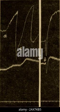 Iniezione endovenosa in shock della ferita: Essendo le lezioni di Oliver-Sharpey consegnate prima del Royal College of Physicians di Londra nel maggio 1918 . ges nella distensione dei capillari a causa della dilatazione o costrizione delle arteriole. Severini (1878) ha descritto la dilatazione dei capillari nel mesentery quando actedon da anidride carbonica, ma Roy e Graham Brown (1879) non sono riusciti a confermare questa dichiarazione. Dale andRichards ha trovato la prova indiretta che l'acido non dilata i capillari nel fatto che la sezione dello spinalcord nella regione cervicale, dopo l'iniezione di acido, non dà un greate Foto Stock