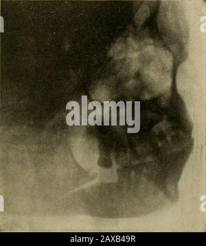 Anatomia applicata e chirurgia orale per gli studenti dentali . r una soluzione completa di conti-nuity; il risultato è stato perfetto Unione e sottosequentrestoration della funzione. Sintomi e diagnosi. - La Frattura del mandibleha i sintomi comuni a fratture di altre ossa, ovvero dolore acuto, crepitio o reticolo sullo sfregamento dell'endstogetere, mobilità pre-ternaturale, deformità, indicatedda malocclusione dei denti, gonfiore e impairedfunction. Il dolore e la tenerezza sono molto più grandi di qualsiasi lesione minore. Quando la frattura si verifica nella porzione della ganascia occupata dai denti, la linea dei denti può essere irre Foto Stock