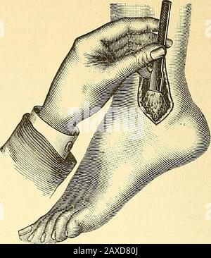 Therapeutisches Lexikon : für praktische Ärzte . Kuiescheibeubruch, s.. Fractui. KuOChenabsCeSS. Die radicale Formder Behandlung kann nur in Aufmeisselungder Corticalis und Entleerung des Eiters BE-. Foto Stock