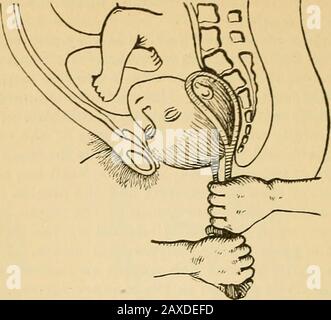 Pratico midwifery; manuale di trattamento . rceps deve essere applicato esattamente ai lati cf la testa, e con le punte anteriori. Le punte dovrebbero essere anteriori a causa dell'impossibilità di securinga afferrare saldamente Avith le pinze invertite. Le lame dovrebbero essere applicate Avith aeeui-acy ai lati della testa, poiché in qualsiasi altra posizione possibile la loro forza di compressione sarebbe posta direttamente all'occorrenza della rotazione, che è l'immediato oggetto dell'operazione. Naturalmente essi dovrebbero essere applicati come vicino all'estremità occipitale della testa come è conveniente; e durante l'applicazione il Foto Stock