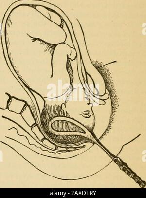 Ostetricia pratica; manuale del trattamento . in secondo luogo, sottopone sia i tessuti materni che quelli fetali a nessun rischio di lacerazione lieve, dal fatto che il suo scivolamento può raramente essere avoidosenza l'applicazione di una quantità pregiudizievole di pressione.Quando viene utilizzato, i tessuti delle madri devono essere sempre protetti dall'inserimento di due dita tra la sua convessità e la parete pelvica. 216 MIDWIFERY PRATICO. Forcipe invertite.: Quando la testa si estende lungo il peri-neum in posizione posteriore, e lias resisteva ai vari metodi di flessione manuale, si dovrebbe ricorrere al funzionamento del re-ver Foto Stock