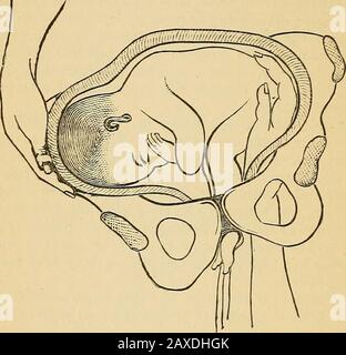 Ostetricia pratica; manuale di trattamento. Zione dovrebbe essere fatto alternativamente su uno o l'altro, o entrambe le gambe. Se la trazione semplice fallisce, essa deve essere integrata da una pressione ascendente sulla parte di presentazione, impiegata sia in al-ternazione con le tracciazioni, sia in coincidenza con esse, e dall'uso di un raccordo come descritto sopra. 184 PKACTICAL MIDWIFERY. In alcuni casi di jresentation completamente trasversale può essere ottenuto, dopo il fallimento dei metodi precedenti, dall'applicazione della seguente manovra. Un cappio è placedaround entrambi i piedi, e la mano che corrisponde al breec Foto Stock