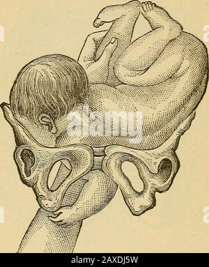 Midwifery pratico; manuale di trattamento. In nessun modo da quello già descritto presentazioni sotto testa. Molto è stato scritto sul vantaggio di essere guadagnato da se-lassando il piede superiore, in versione per presentazione trasversale; ma poichè questa vista non ha ottenuto mai molta credence fuori dell'Inghilterra, E come ultima autorità britannica, Gralabin, non onlydisapprovs di questa pratica, ma dà un mechi-180 molto convincente MIDWIFERY PRATICO. EAL prova della fallacia della teoria che la ha spinta, il subject-ject bisogno di non essere più di menzionato qui. A meno che non sia necessario prestare particolare attenzione per selezionare la su Foto Stock