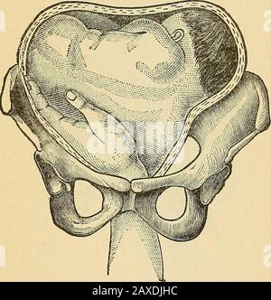 Ostetricia pratica; manuale di trattamento. Anesimo di evoluzione spontanea. Naturalmente, durante questa intera joroeess la contropressione più attenta deveessere mantenuta al fondo. In casi semplici un braccio lorolajDsed può essere usato come un comodo da cui spingere la spalla, e in tutti i casi iswell per iniziare l'operazione da noosing un filetto intorno alla CHIRURGIA pro-OSTETRICA. 179 polso lappato. Ciò risponde ad un duplice scopo: Può essere utilizzato, dapprima per estrarre il braccio dalla mano di lavoro; e, in secondo luogo, durante il processo di estrazione leggere tracciamenti sul raccordo PR Foto Stock