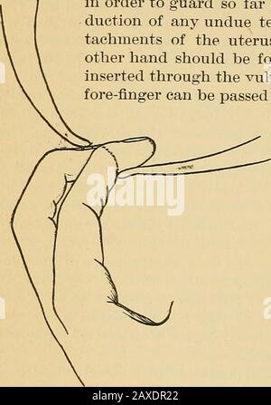 Pratica midwifery; manuale di trattamento. Ced fianco a fianco, in quale posizione hanno pre-inviato la superficie più grande toit. Per tutta la conformità di questa operazionedè opportuno ricordaredche il os uteri non è semplicemente una fascia elastica, né è in grado di distentarsi in qualsiasi grado marcato dopo la maniera di un pezzo di gomma, ma è, d'altra parte, tessuto vivente che può essere dilatato solo dal rilassamento delle fibre circolari della cervice, e che questo rilassamento è il risultato di una graduale fatica da mus-cnleiv dovuta alle loro estrazioni prolungate contro l'ostacolo opposto alla loro contrazione Foto Stock