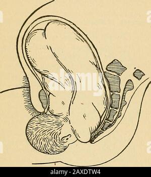 Pratica ostricia; manuale di trattamento. Della testa sul tronco, da cui la fronte, il viso e il mento sono successivamente spazzati sopra la tefourchette e Ijrugged nel mondo. Questo movimento di ex-tensione inizia di solito al momento che le grandi fontanelle ajo-pere al bordo della perina-um. Consegna del corpo.- al tempo Avhen la testa emerge theshoulders sono ancora nel canale pelvico, che naturalmente entrano NEL LAVORO. 97 in tlio di fronte a diainetev obliquo, e come la continuità delle contrazioni uterine spinge theui in avanti, la loro rotazione sotto le stesse forze si traduce in m tlie Foto Stock