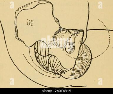 Midwifery pratico; manuale di trattamento. E notch, e riempito solo con tessuto molle e cedevole. L'occipito essendo esposto ad un'eccesof pressione sulla sua superficie posteriore, e il occipito ad un'eccesof pressione anteriormente, il risultato è la rotazione; Ma si deve notare che questo dipende dalla flessione, poiché se si perde la flessione, e 9G PRATICO MIDWIFERY. Il sinciput e occiput occupano un[)i)roxiuiuiately lo stesso planedel bacino, l)otli sono expo.sed ad un eccesso di pressione su(jii thesame lato, e non c'è nulla da produrre la rotazione. Quando queste forze hanno portato alla rotazione, th Foto Stock