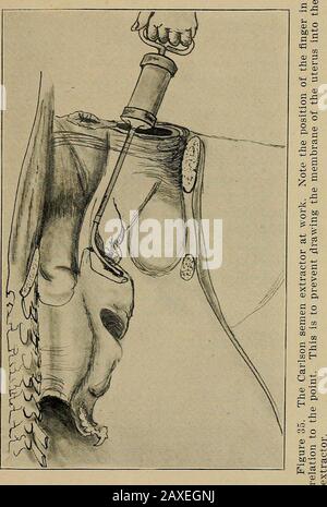 Studi nell'allevamento di cavalli; un trattato illustrato sulla scienza e la pratica dell'allevamento di cavalli . che riveste l'utero,iniziare a riempire il cilindro dell'estrattore con l'estrazione sulla biella con la mano sinistra. Una volta riempito il cilindro, raddrizzare il punto prima di disegnarlo sulla mare e iniziare la sala operatoria come prima indicato. Chiedere all'aiuto o all'assistente di maneggiare l'estrattore, che deve essere tenuto sotto l'eccettoacqua quando si riempiono le capsule. Il dito deve sempre essere keptover l'apertura del punto, per escludere sia aria che acqua, quando non si riempie una capsula. Con tappi Foto Stock