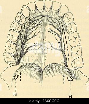 Un manuale di chirurgia operativa. L'apporto di sangue al palato, sia duro che morbido, è quasi totale derivato dall'arteria palatina posteriore, un ramo discendente dal maxil-lary interno. I vasi posteriorpalatina emerogeattraverso l'osso, con regolazione interna alla presa per l'ultimo toothrand molare, e il ramo per i corsi di palato thehard per-verso l'incisveforame, parallelo al margine tealveolare. La linea tratteggiata nella figura sopra mostra dove deve essere posizionata l'incisione, cioè deve essere regolabile all'interno del bordo alveolare ed all'esterno della scanalatura per l'arteria A. Foto Stock