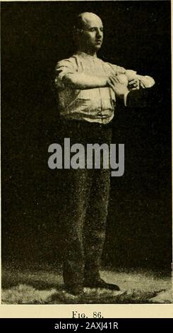 Malattie del cuore e del sistema arterioso : concepito per essere una presentazione pratica del soggetto per l'uso di studenti e professionisti della medicina . Fig. 85.. Foto Stock