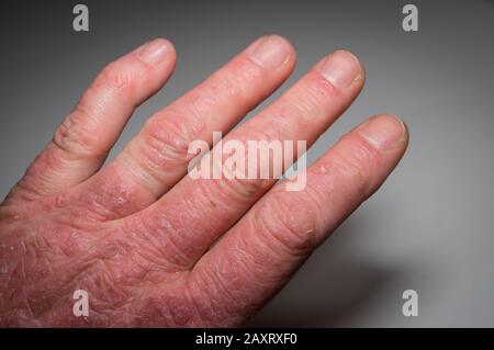 Mano di un paziente psoriasi primo piano. Artrite psoriasica. Deformazione e infiammazione delle articolazioni sulla pelle. Foto con vignettatura scura.fuoco morbido. Foto Stock