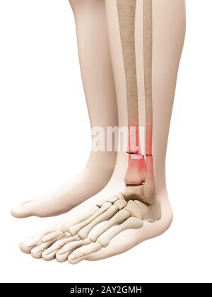 Illustrazione medica di una gamba rotta osso Foto Stock