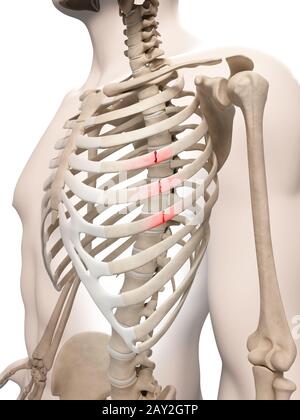 Illustrazione medica di costole rotte Foto Stock