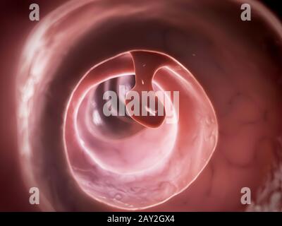 3d reso illustrazione di un polipo del colon Foto Stock