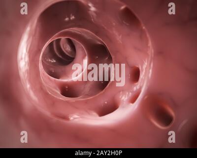 3d reso illustrazione di diverticolite Foto Stock