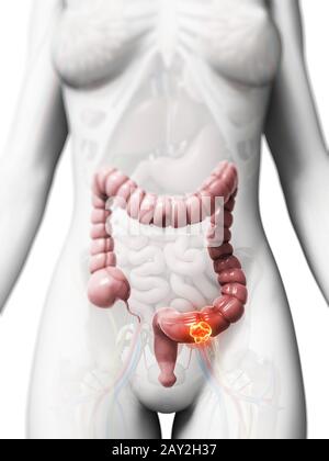 3d reso illustrazione di cancro al colon Foto Stock