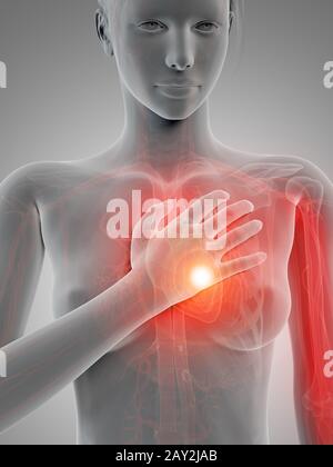 illustrazione 3d medica - attacco cardiaco Foto Stock