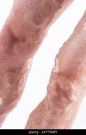 Persone con vene varicose delle estremità inferiori e t venosa Foto Stock