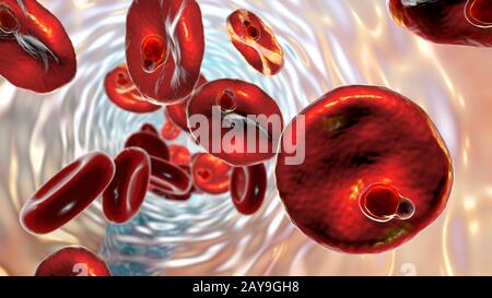 Plasmodium malariae all'interno dei globuli rossi, illustrazione Foto Stock