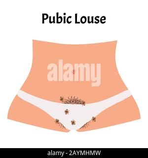 Malattie parassitarie di Phtiriasis. Pediculosi pubis. Struttura di ghiaccio pubico. Malattie sessualmente trasmissibili. Infografiche. Illustrazione del vettore attivata Illustrazione Vettoriale