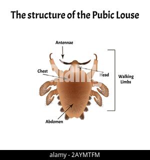 Malattie parassitarie di Phtiriasis. Pediculosi pubis. Struttura di ghiaccio pubico. Malattie sessualmente trasmissibili. Infografiche. Illustrazione del vettore attivata Illustrazione Vettoriale